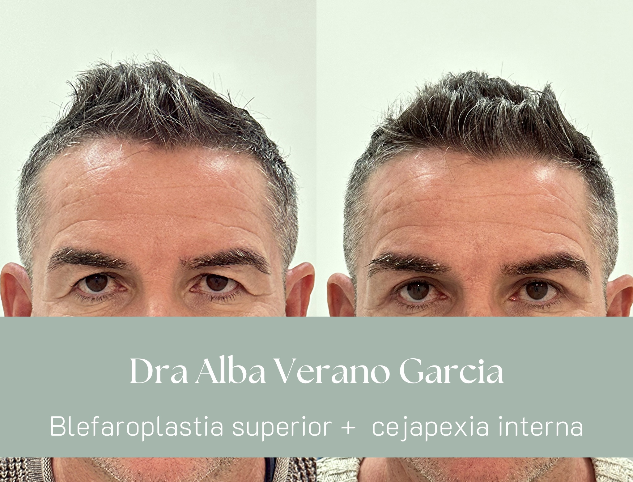 blefaroplastia superior en sevilla